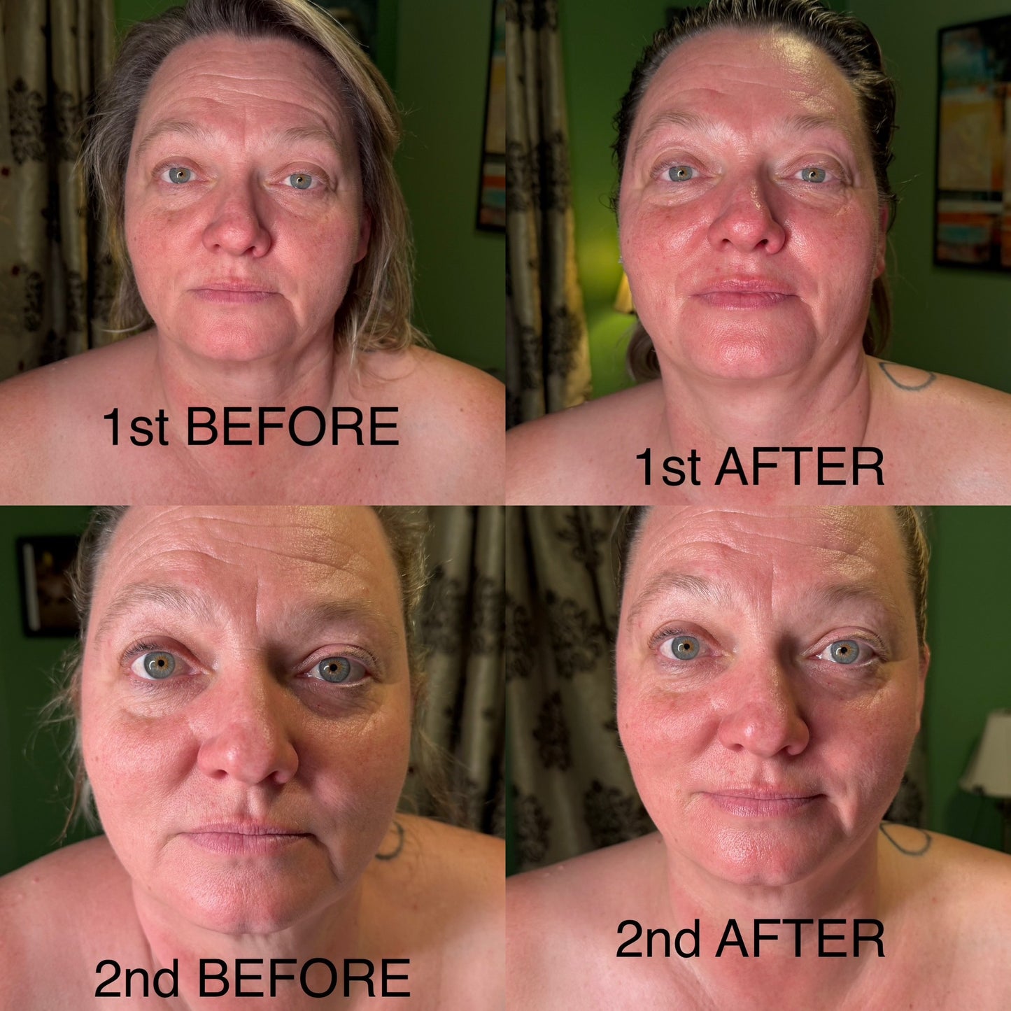 Extensive Buccal Facelift With Lymphatic Drainage & Myofacial Release Treatment (Includes LED Light Therapy) 100 Minutes