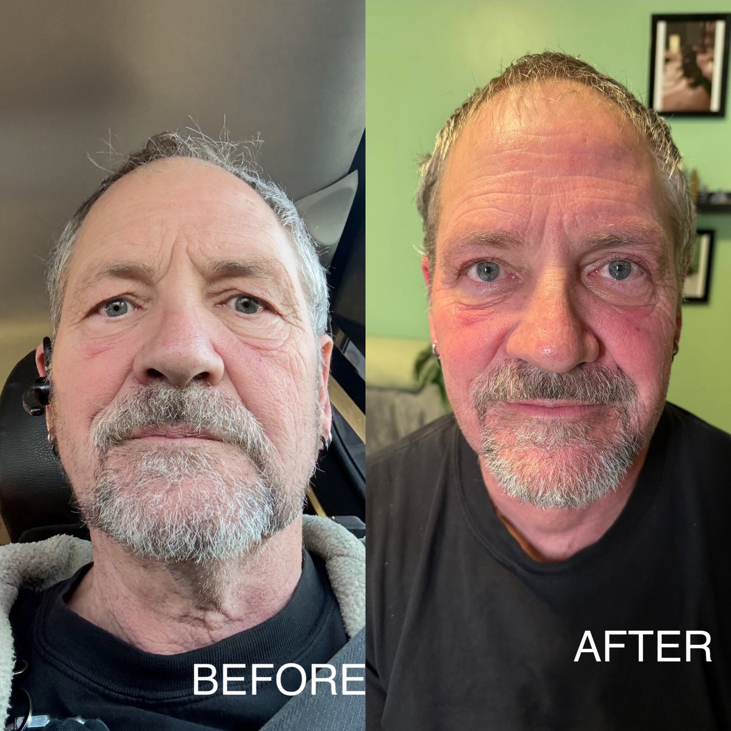 Extensive Buccal Facelift With Lymphatic Drainage & Myofacial Release Treatment (Includes LED Light Therapy) 100 Minutes